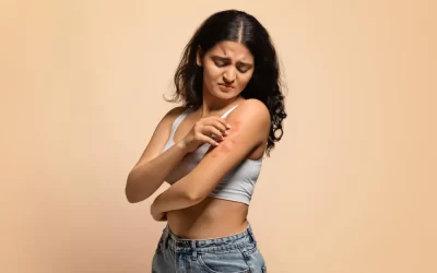 Como saber se é percevejo de cama ou alergia comum?